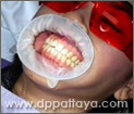 4.สวมอุปกรณ์ช่วยถ่างปาก (Oral Gate) เพื่อช่วยพยุงริมฝีปากตลอดกระบวนการฟอกสีฟัน 30 นาที.