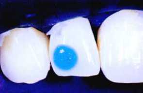 Apply Heliobond on tooth surface