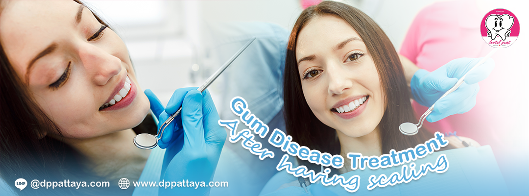 Gum Disease Treatment After having scaling Gum Disease Treatment After having scaling