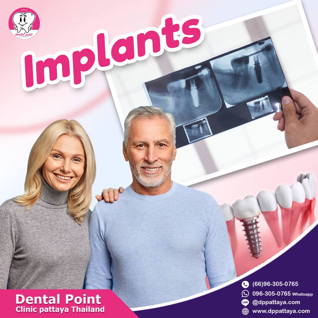 Implants Implants