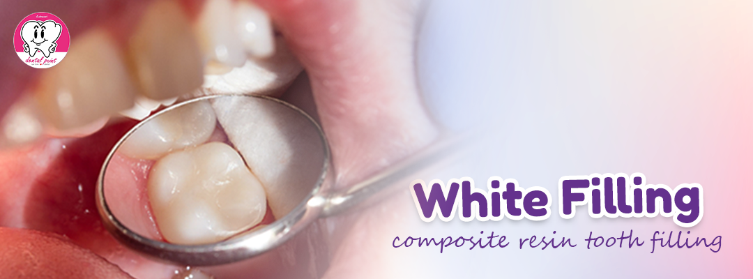 composite resin tooth filling
