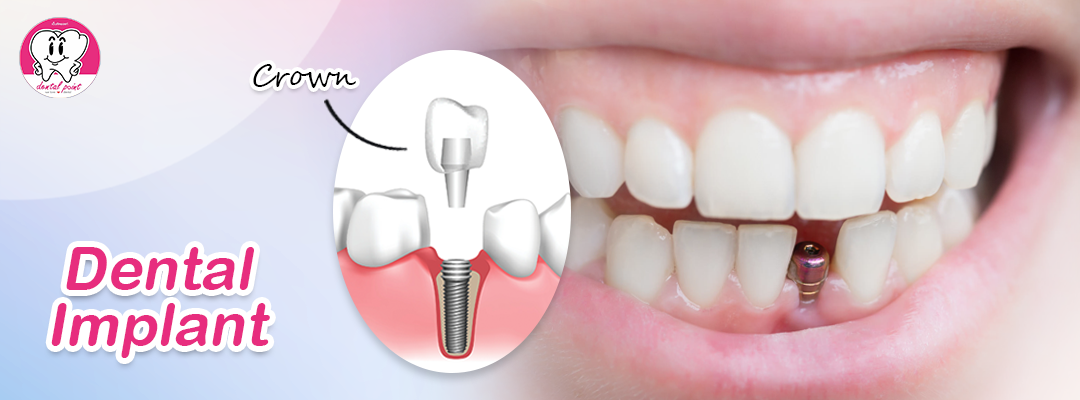 dental Implants dental Implants