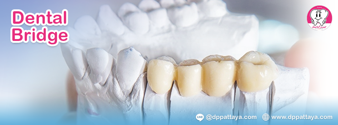 Dental Bridge Dental Bridge