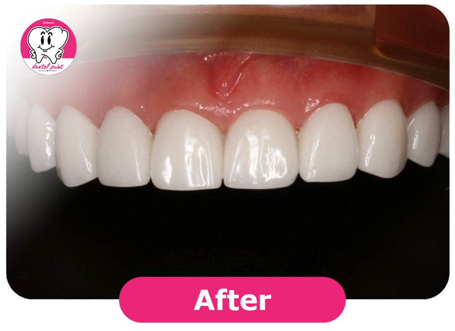porcelain veneers review after porcelain veneers review