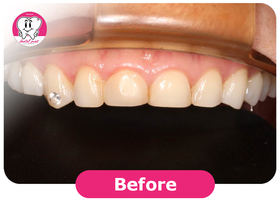 porcelain veneers review porcelain veneers review