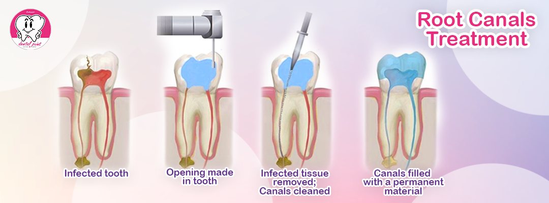 root canal treatment procedure root canal treatment procedure