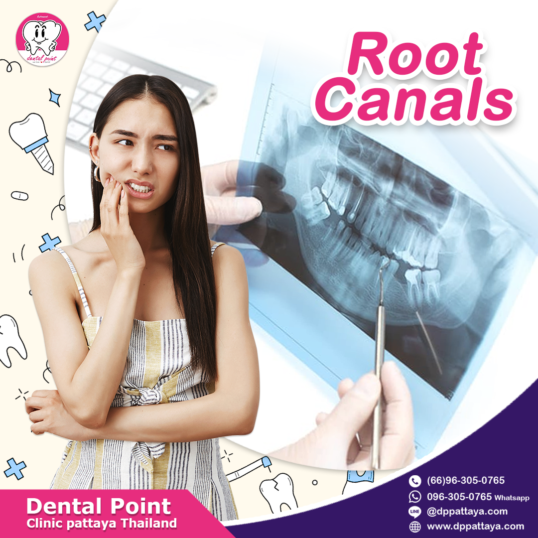 root canals root canals