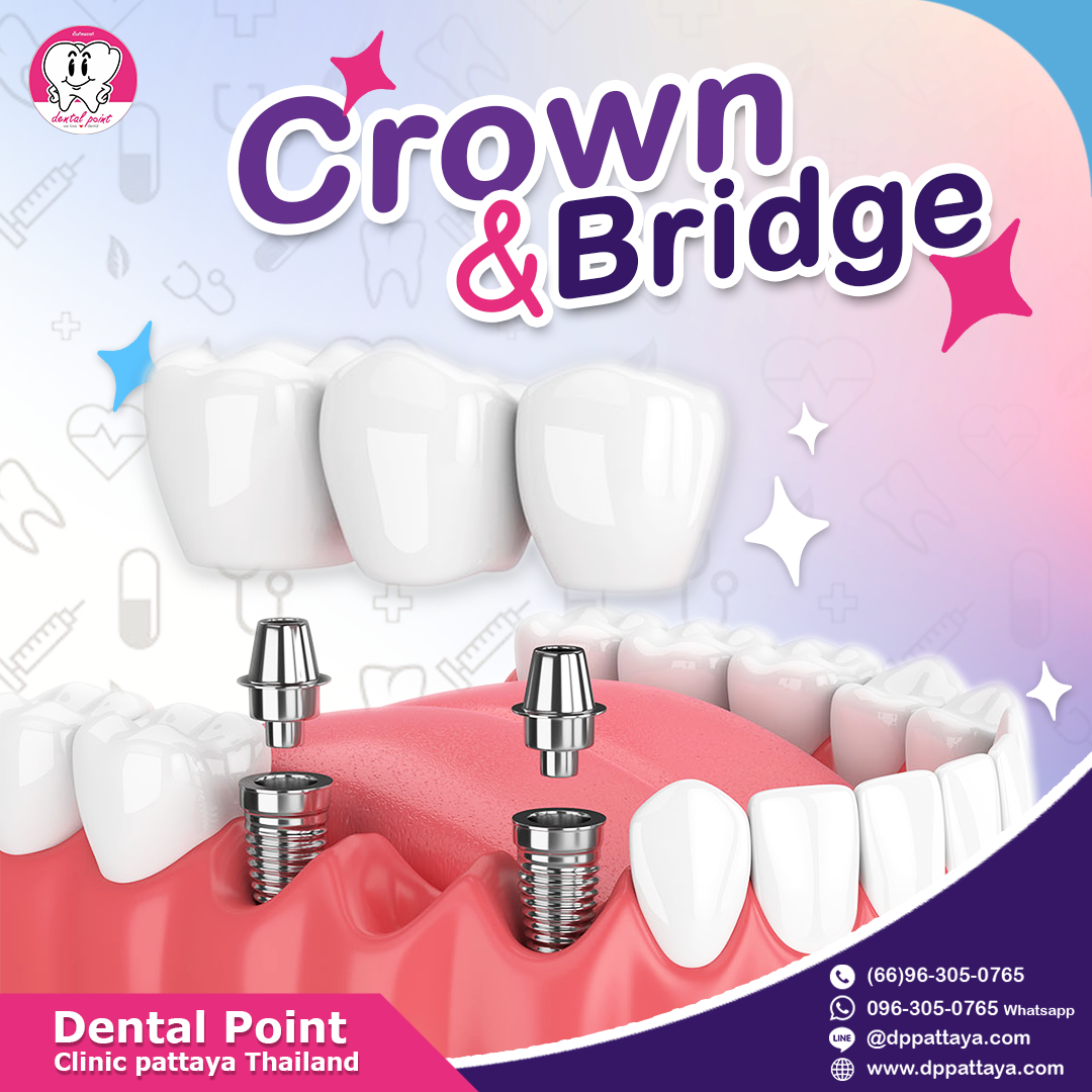 Dental Crowns And Tooth Bridges