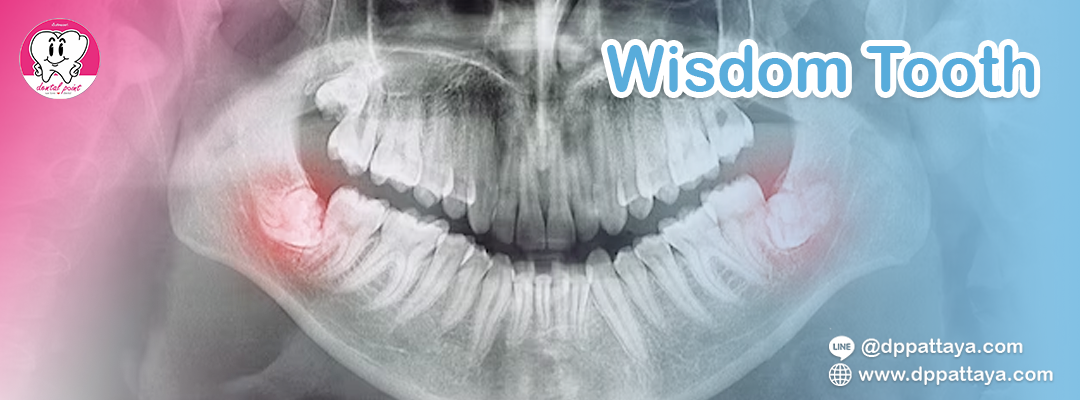Wisdom tooth Wisdom tooth