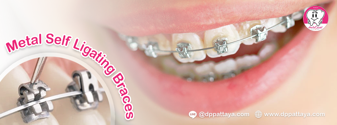 metal self ligating braces metal self ligating braces