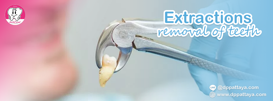 removal of teeth extractions - dental surgery