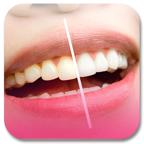 teeth whitening program