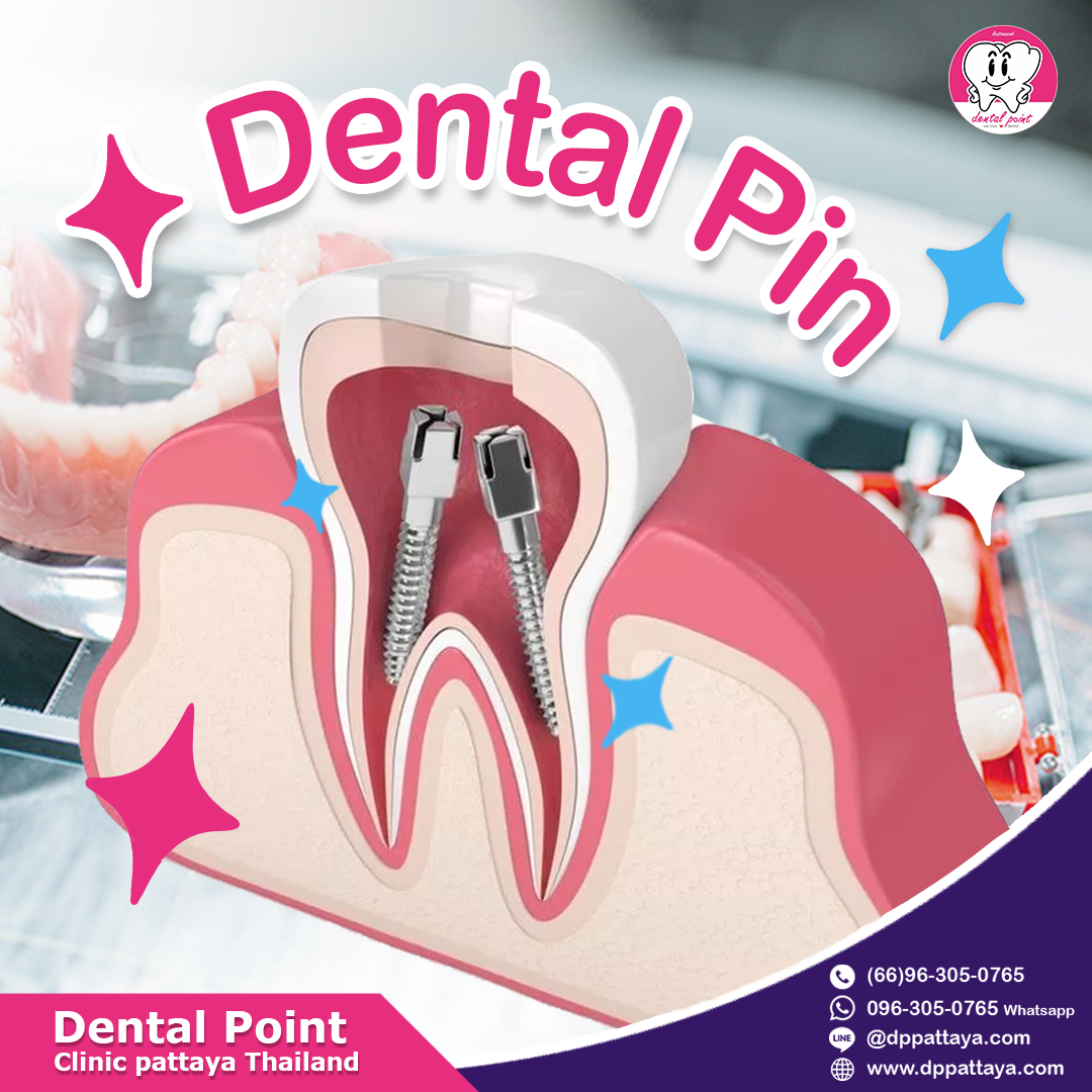 Dental Pin
