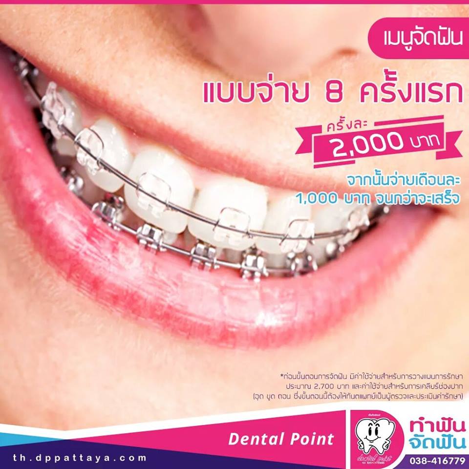 โปรโมชั่นจัดฟันเหล็ก เลือกได้ ฉบับมนุษย์เงินเดือน