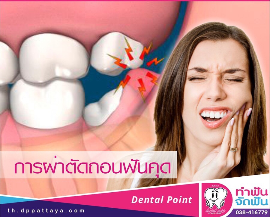ถอนฟันและผ่าฟันคุด การผ่าตัดถอนฟันคุด