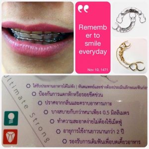 รีเทนเนอร์แบบใส่รับประทานอาหารได้ (All Metal Retainer)