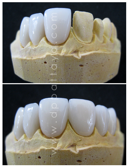 พอร์ซเลนวีเนียร์ หรือเคลือบฟันเทียมเซรามิกส์แบบติดแน่น