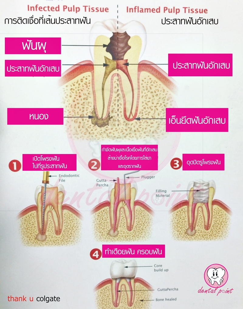 ข้อควรรู้เกี่ยวกับการรักษารากฟัน