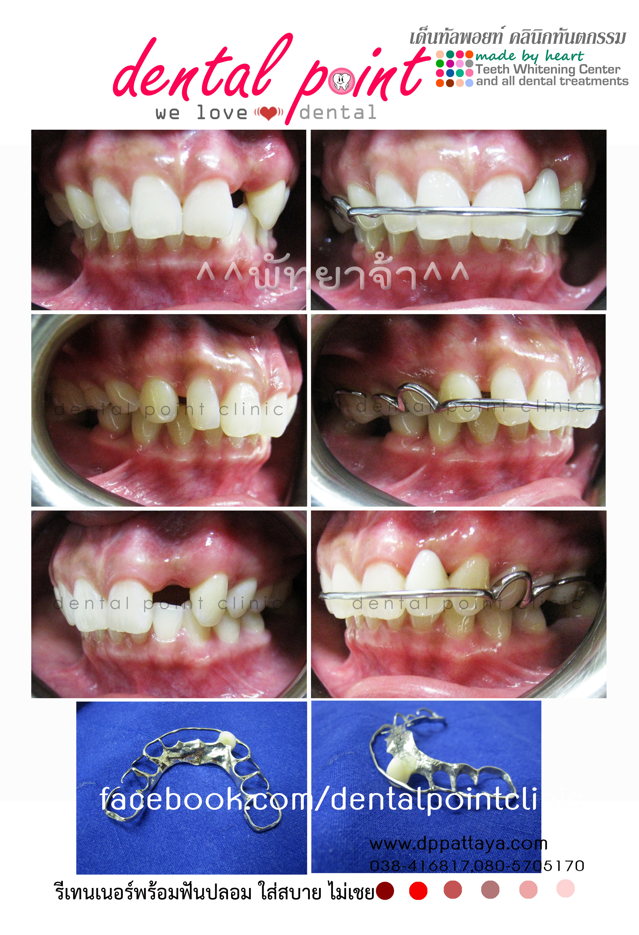 รีเทนเนอร์แบบเติมฟันใช้แทนฟันปลอม