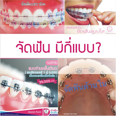 ประเภทของการจัดฟัน