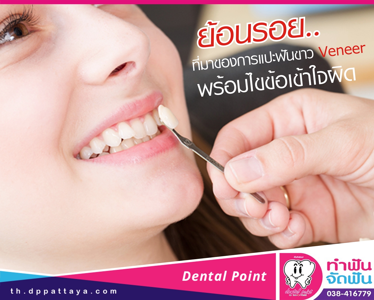 ย้อนรอยที่มาของการแปะฟันขาว Veneer พร้อมไขข้อเข้าใจผิด