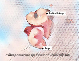 ฟันคุด คือ ผลที่ตามมาเมื่อคนไข้ไม่ยอมผ่าฟันคุด