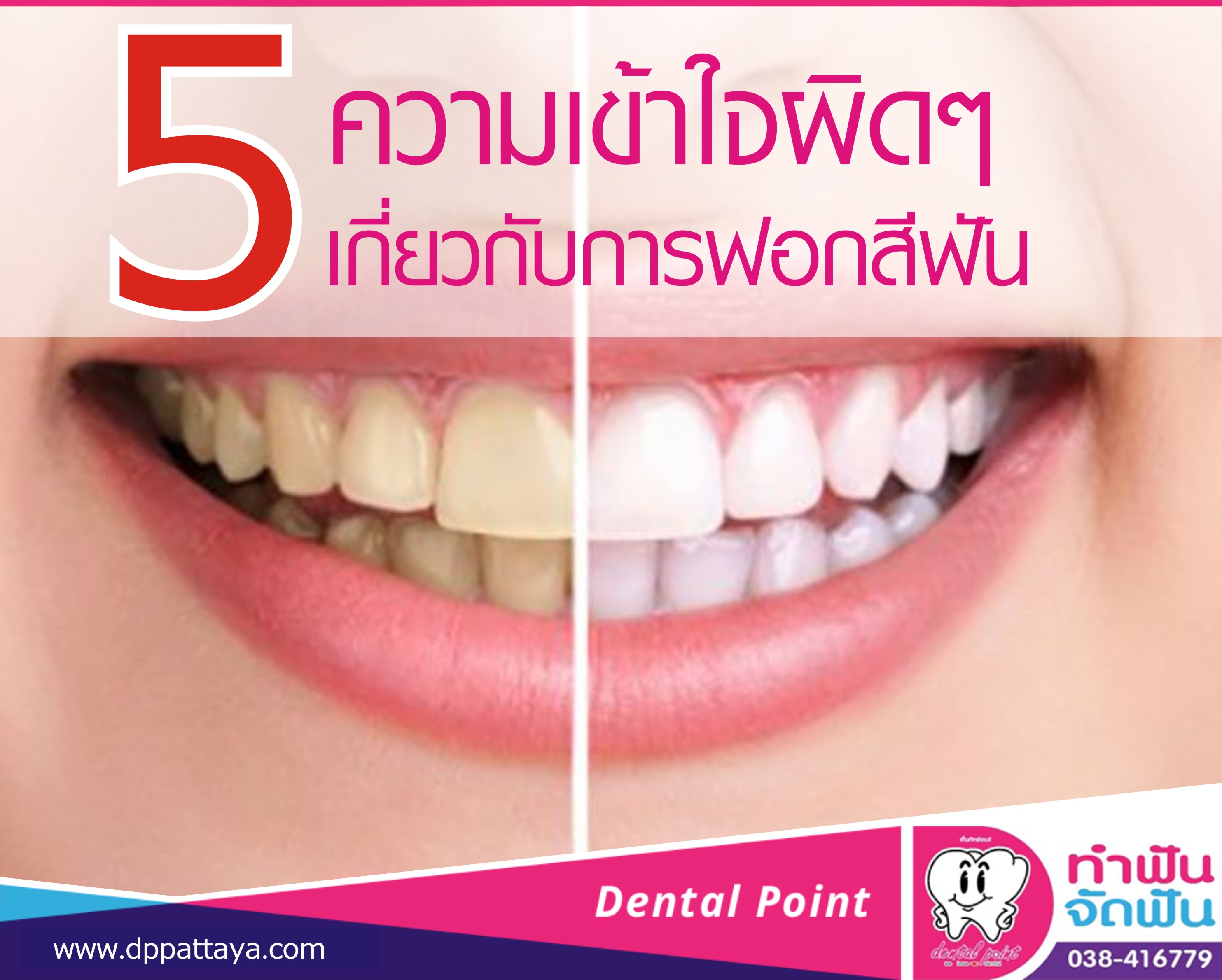 5 ความเข้าใจผิดๆเกี่ยวกับการฟอกสีฟัน