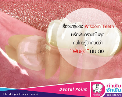 เรื่องน่ารู้ของ Wisdom Teeth หรือฟันกรามซี่ในสุด คนไทยรู้จักกันดี ว่า ฟันคุด นั่นเอง