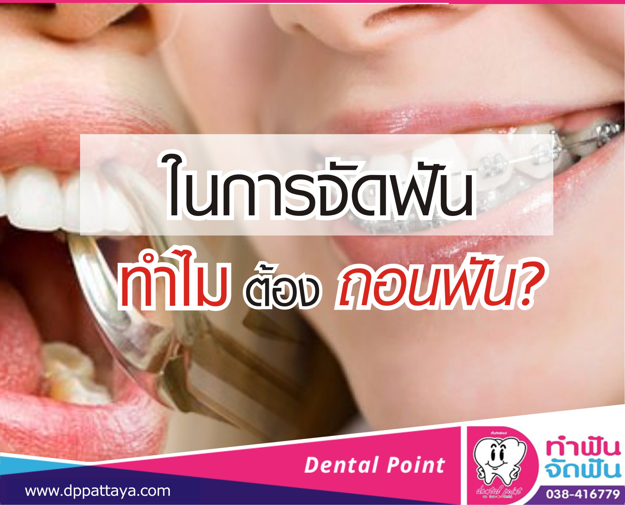 ในการจัดฟัน ทำไมต้องถอนฟัน?