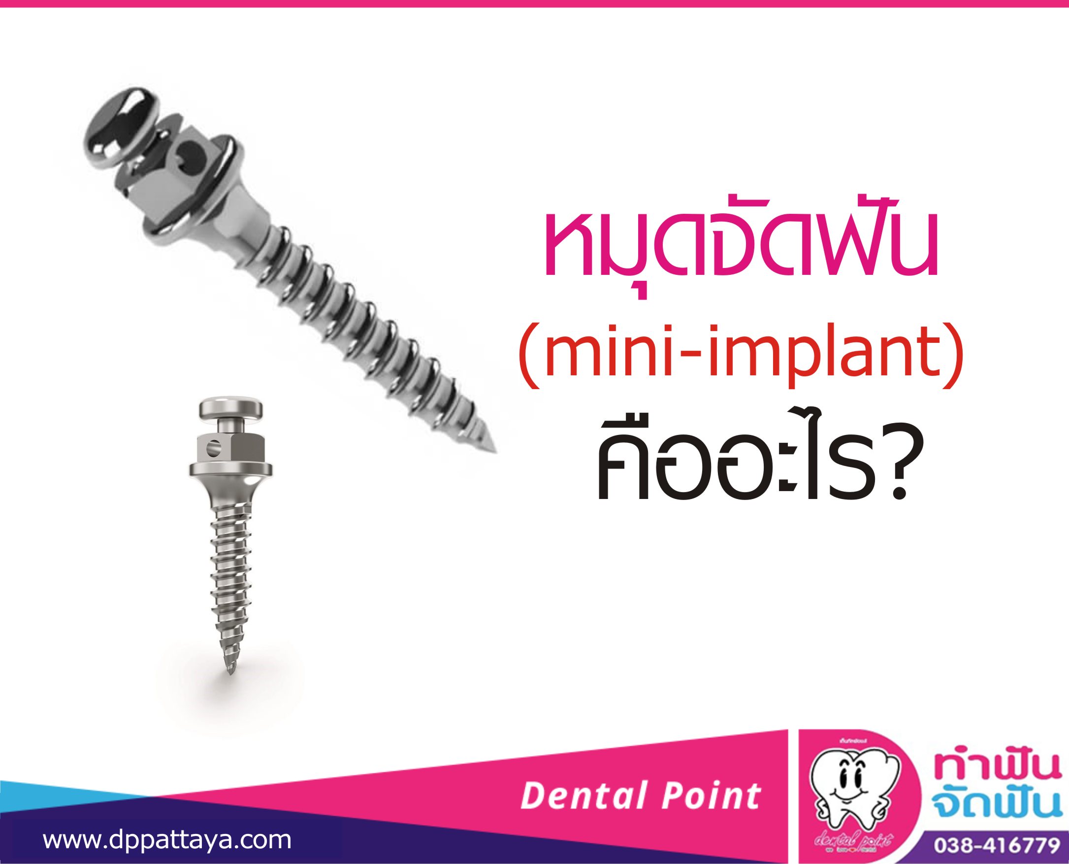 หมุดจัดฟัน (mini-implant) คืออะไร?
