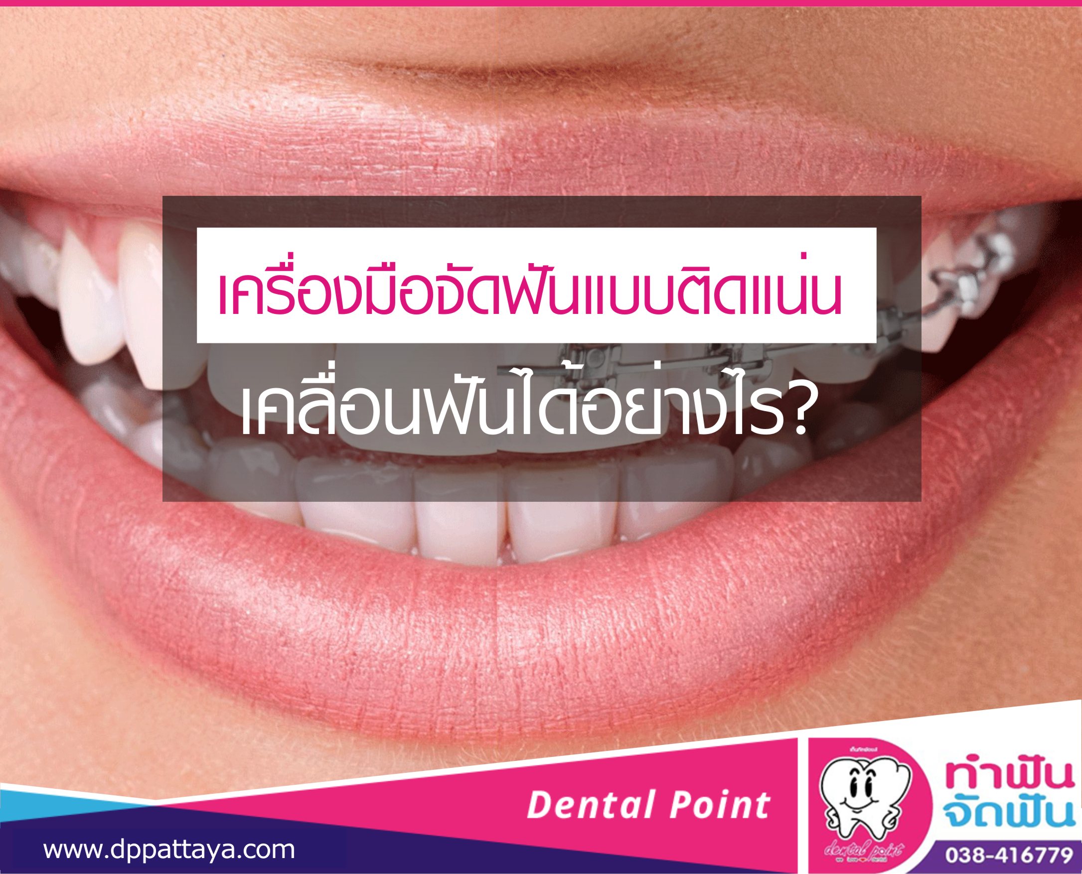 เครื่องมือจัดฟันแบบติดแน่น เคลื่อนฟันได้อย่างไร?