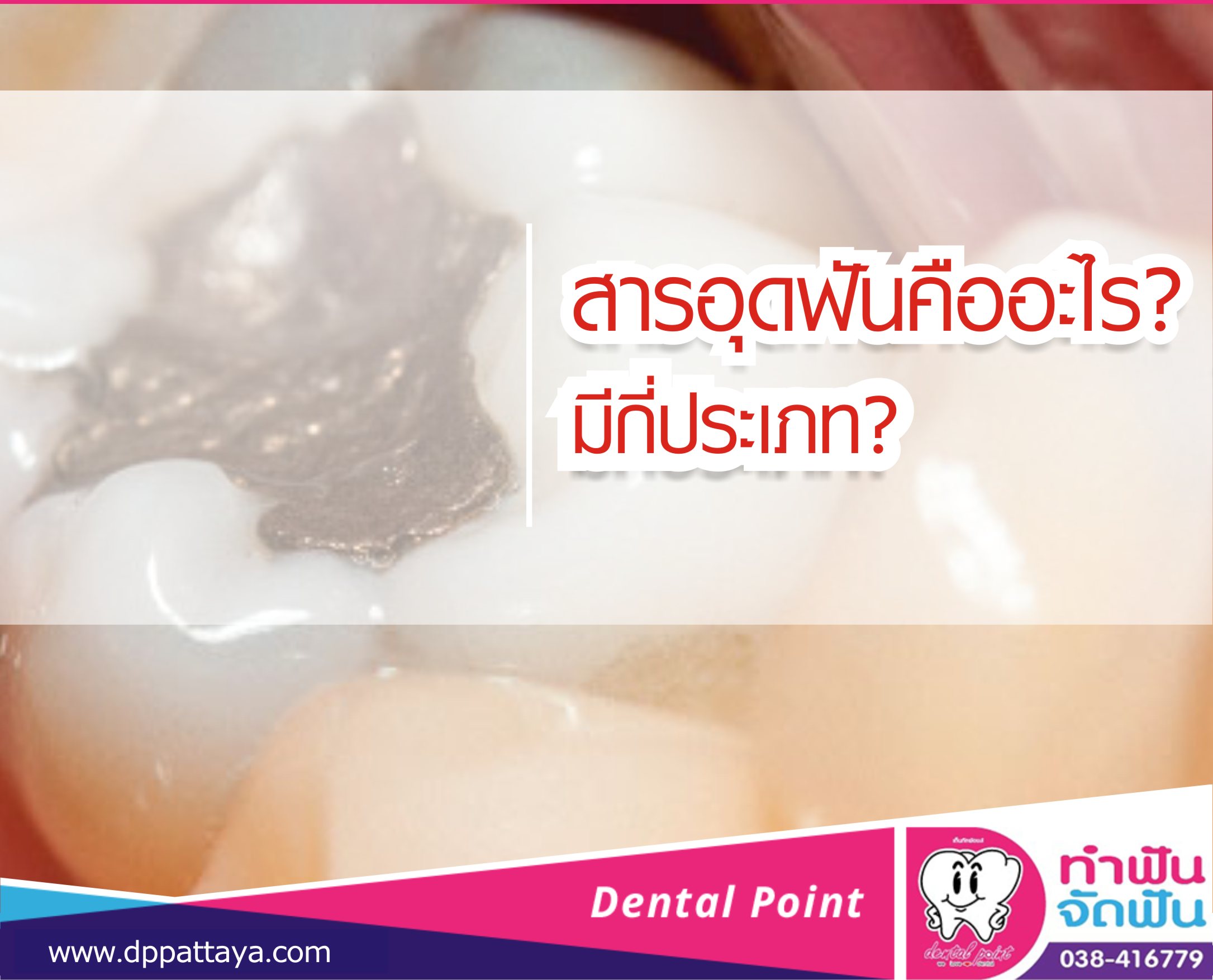 สารอุดฟันคืออะไร? มีกี่ประเภท?