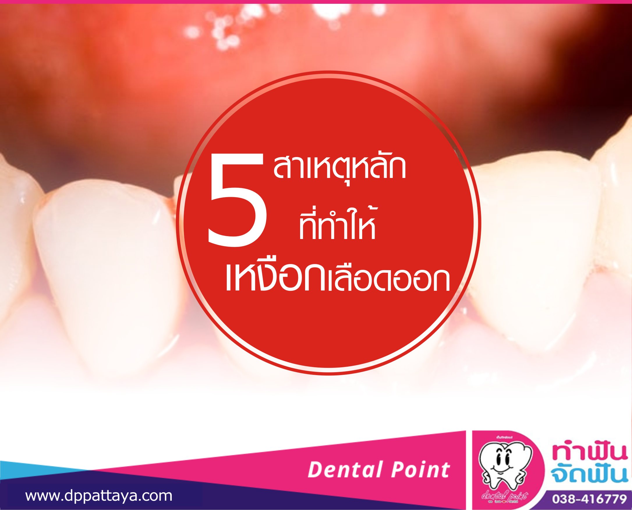 5 สาเหตุหลักที่ทำให้เหงือกเลือดออก