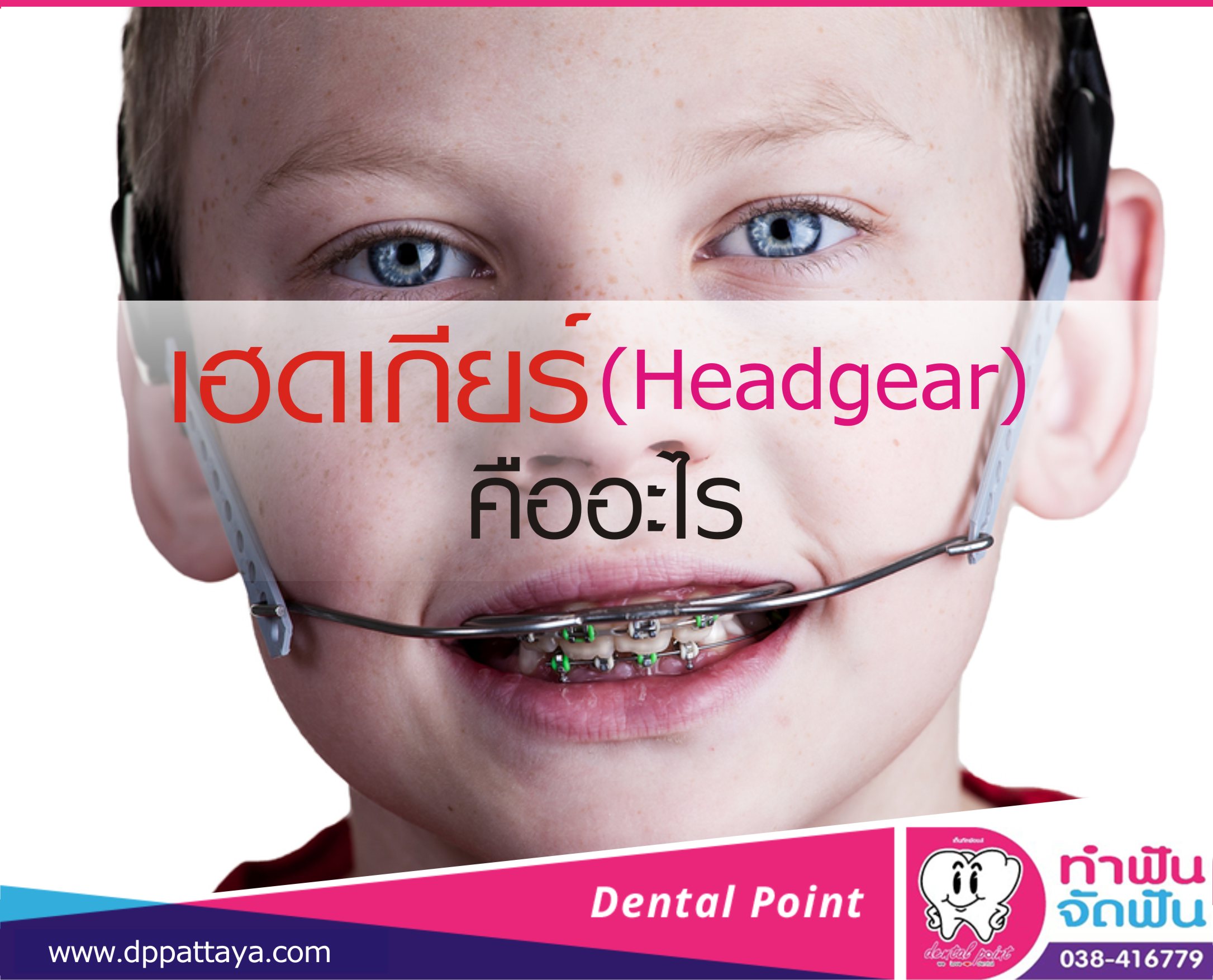 เฮดเกียร์ (Headgear) คืออะไร?