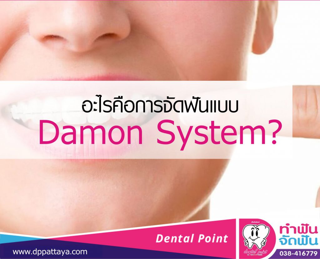 จัดฟันแบบ Damon System