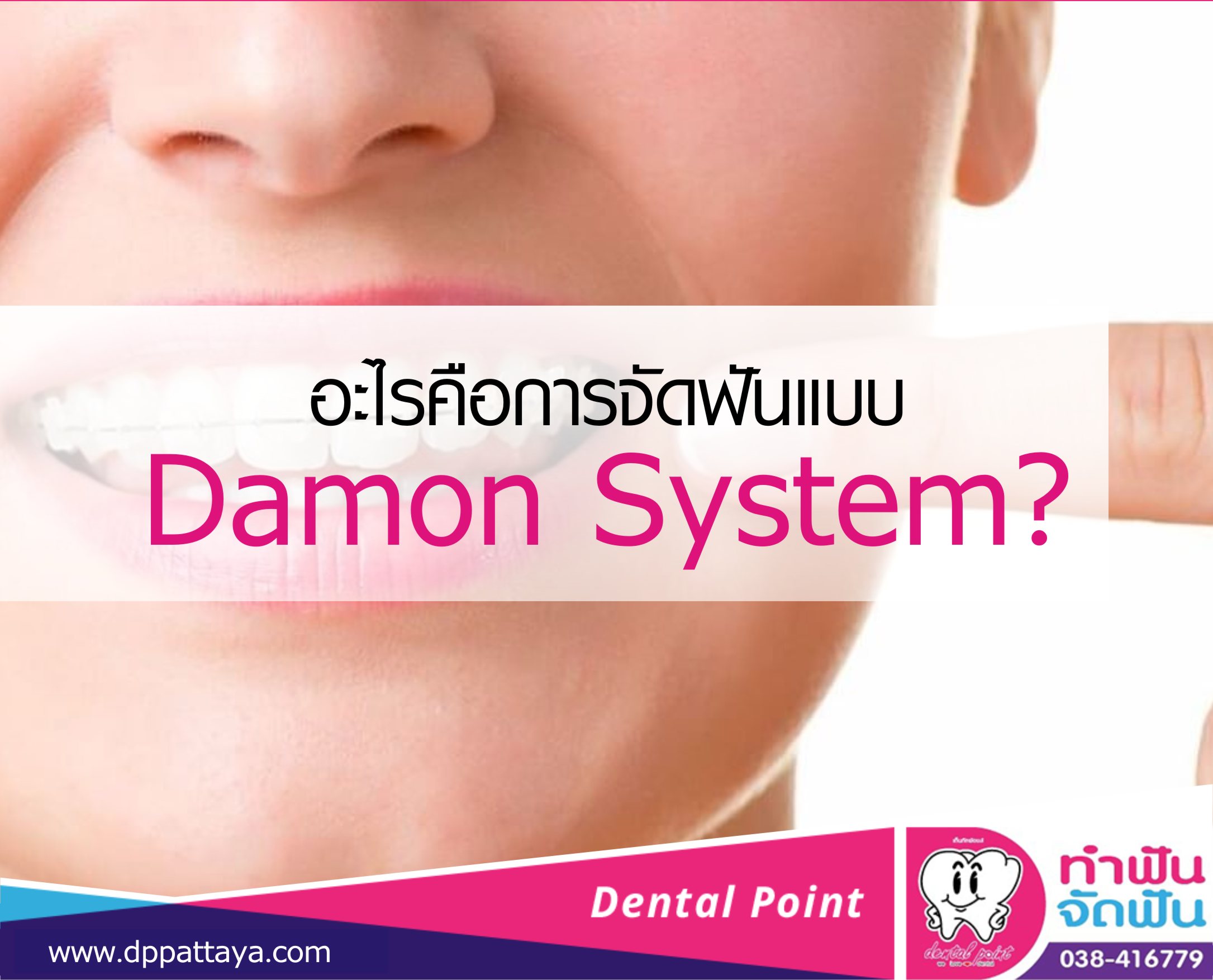 อะไรคือการจัดฟันแบบ Damon System?