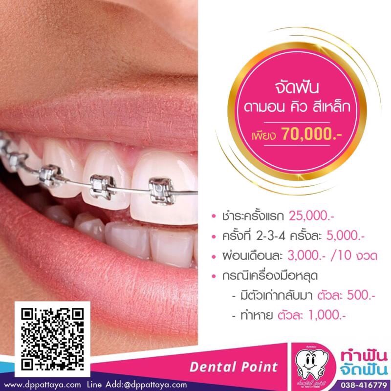 จัดฟันดามอนคิว ราคา