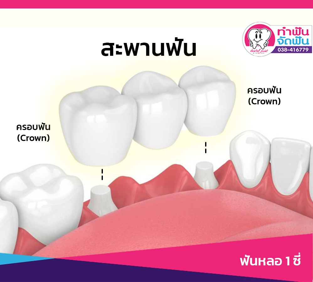 ฟันหลอ 1 ซี่ สะพานฟัน ราคาฟันปลอมชนิดติดแน่น