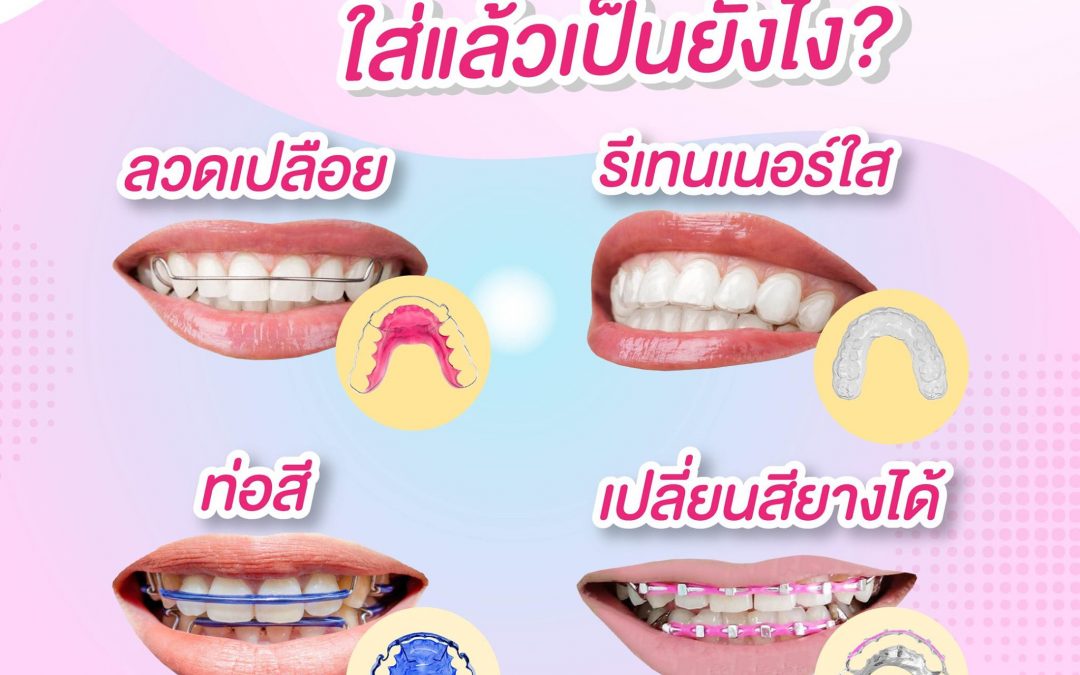 รีเทนเนอร์