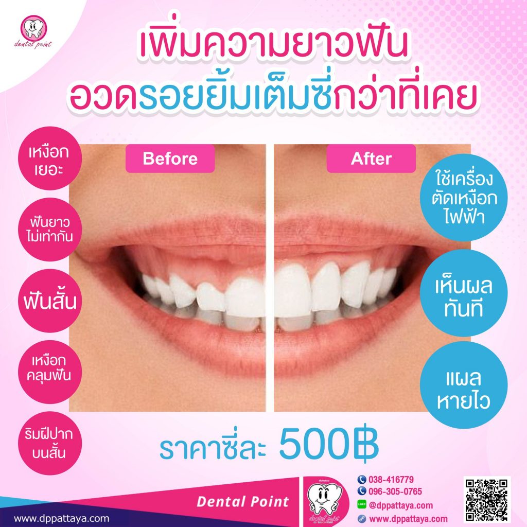 ตัดเหงือกราคา ยิ้มเห็นเหงือก