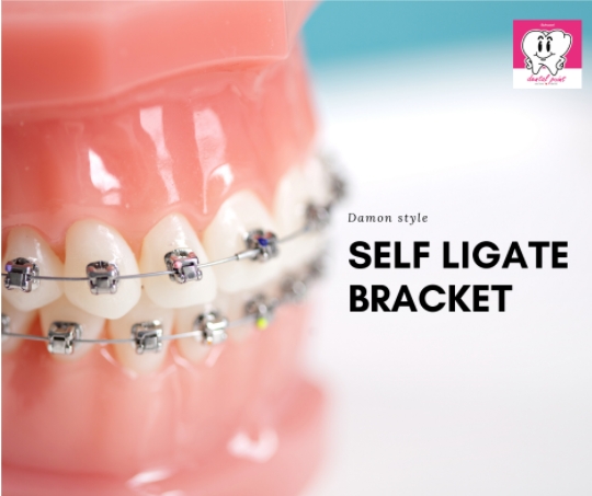 Self Ligate Bracket