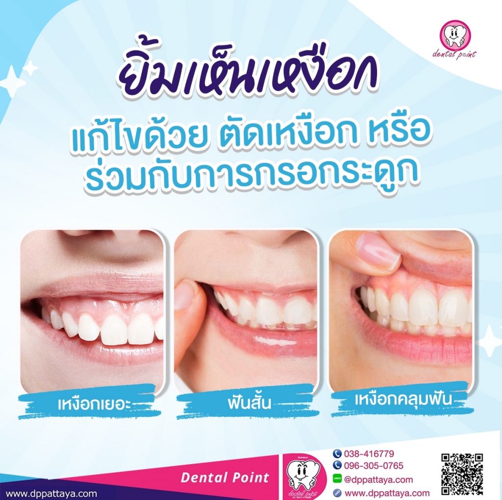 ตัดเหงือก ยิ้มเห็นเหงือก