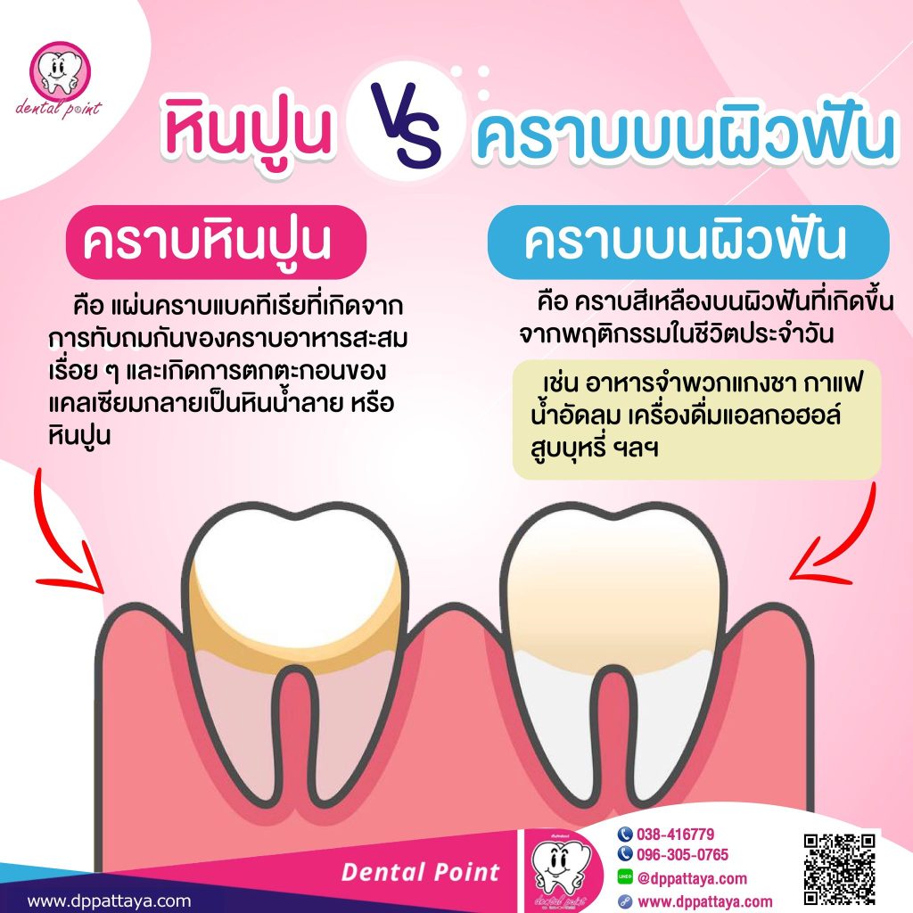 กำจัดคราบฟันเหลือง