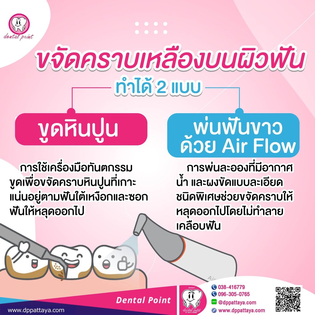 ขจัดคราวฟันเหลือง airflow