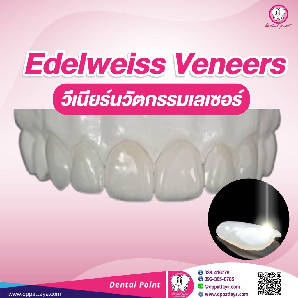 Edelweiss Veneers วีเนียร์สำเร็จรูปนวัตกรรมเลเซอร์