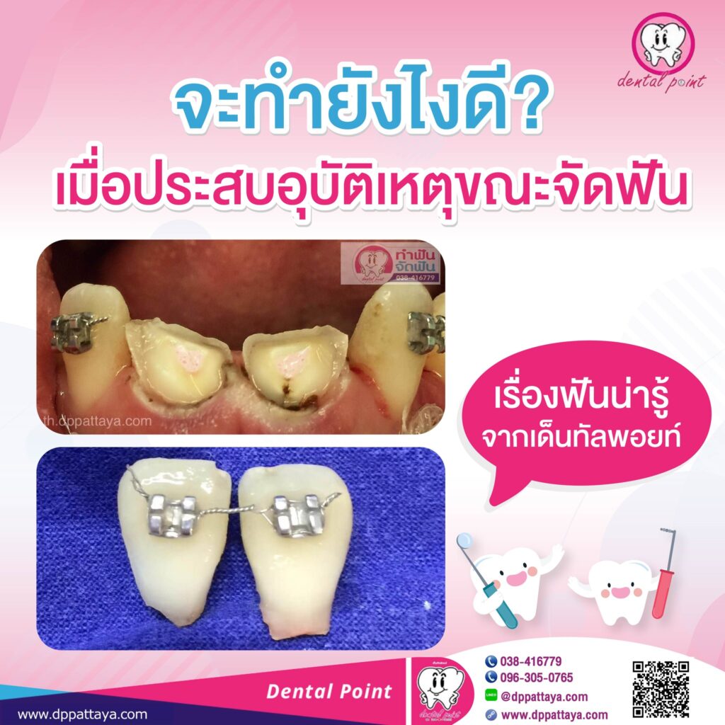 อุบัติเหตุฟันหักขณะจัดฟัน